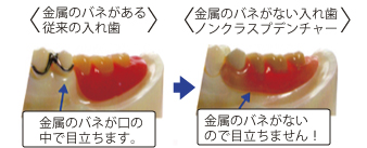 [金属のバネがある従来の入れ歯]金属のバネが口の中で目立ちます。/[金属のバネがない入れ歯ノンクラスプデンチャー]金属のバネがないので目立ちません！